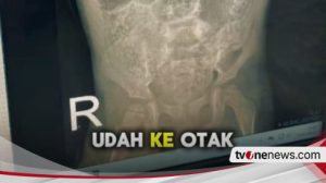 68a547a713803-nasib-pilu-anak-di-sukabumi-meninggal-dunia-gara-gara-cacingan-akut-cacing-15-cm-bisa-ditarik-dari-lubang-hidung-bapak-sakit-dan-ibu-odgj_488_274.jpg